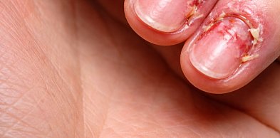 Bolące paznokcie po hybrydzie – przyczyny, regeneracja i skuteczne sposoby pielęgn