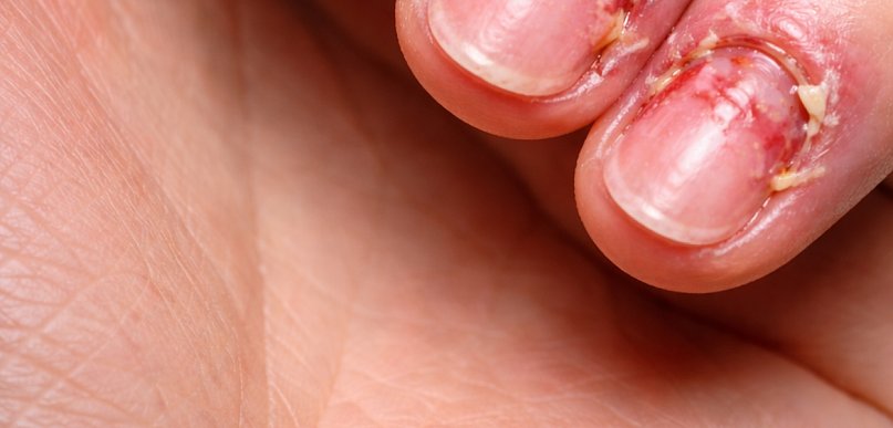 Bolące paznokcie po hybrydzie – przyczyny, regeneracja i skuteczne sposoby pielęgn