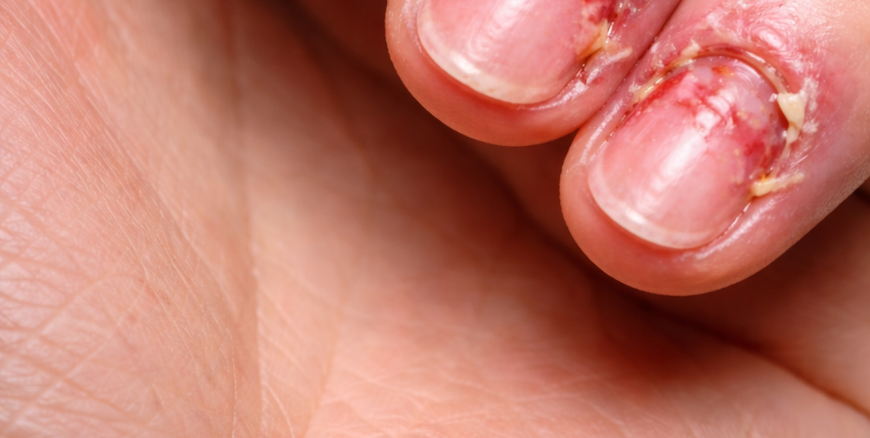 Bolące paznokcie po hybrydzie – przyczyny, regeneracja i skuteczne sposoby pielęgn